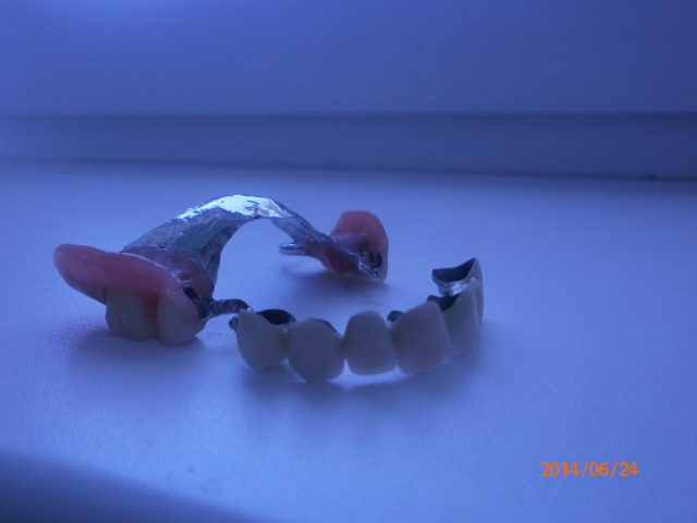 протезирование зубов- съемные протезы в томске